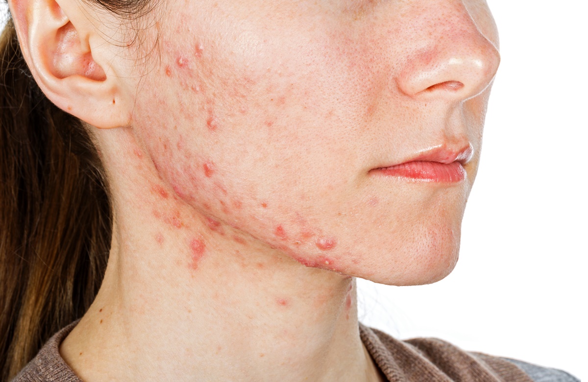 Acne: Entendendo, Tratando e Convivendo com a Pele Imperfeita